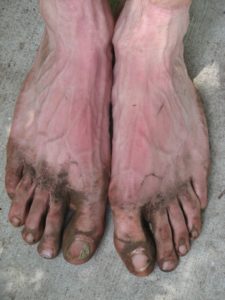 Dirty-feet- How to Prevent and Treat Blisters.